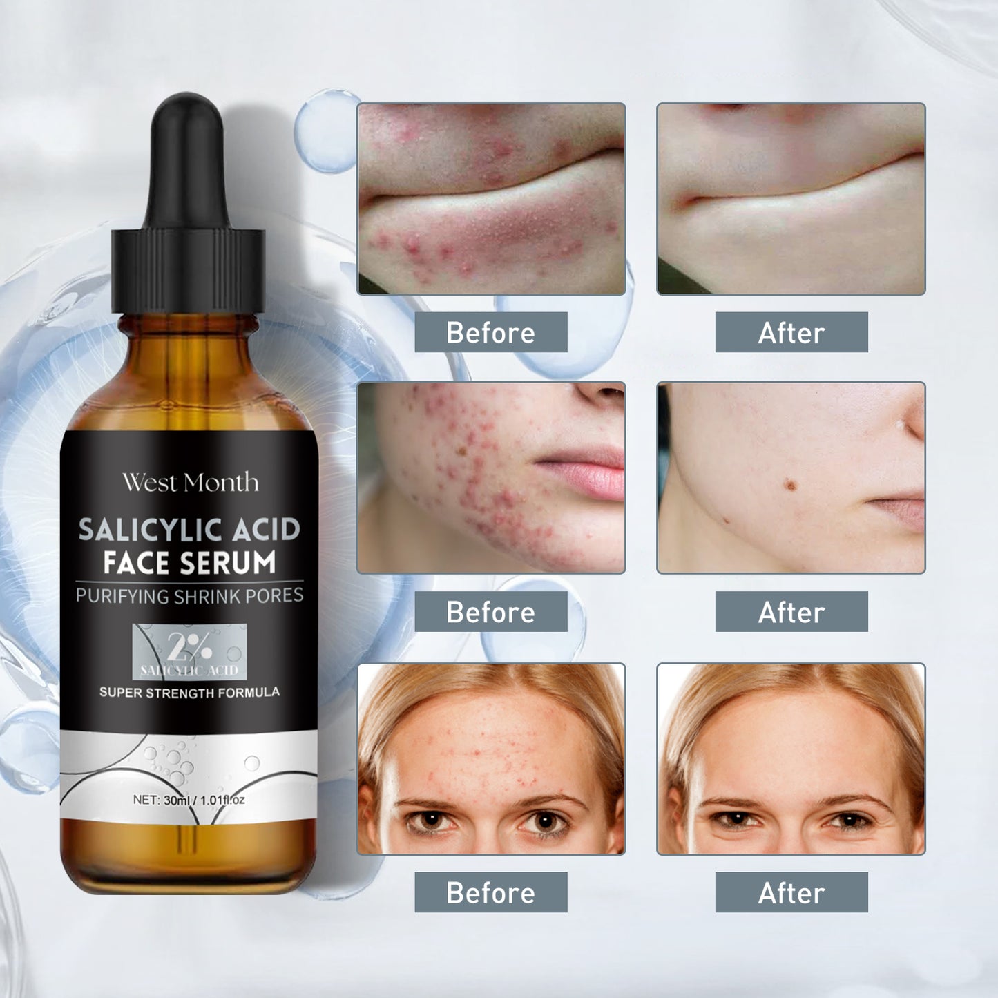 Salicylic Acid Facial Essence, Lighten Acne Mark Repair Hydrating Facial Care Essence