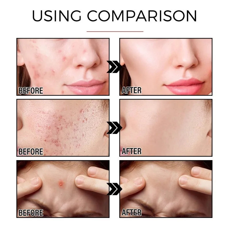 Acne Patch Pimple Cover Repair Facial Acne Treatment Smooth Skin Care Non-Irritating Mild Acne Pimple Patch