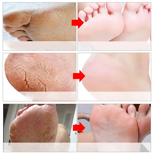 60% Urea Foot Cream Feet Heel Anti-Chapping Ultra-hydrating Softening Dry Cracked Product Gentle Exfoliation Daily Hand Foot Car