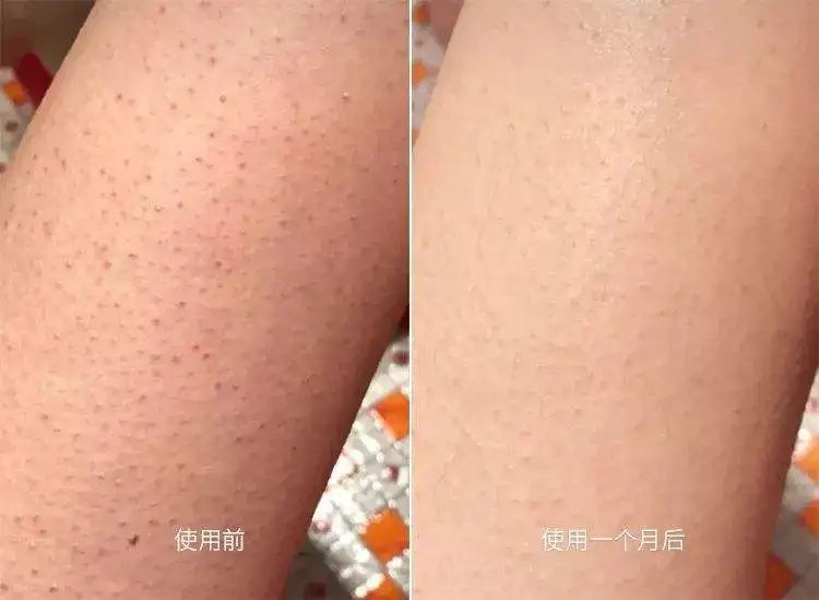 300g/10.58 OZ Curing Keratosis Pilaris Chicken Skin Body Lotion Skin Repair Cream Skin Care Essence Moisturizing And Nourishing