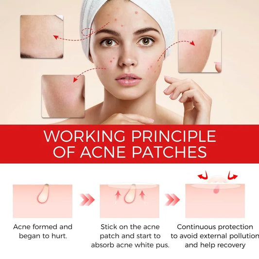 Acne Patch Pimple Cover Repair Facial Acne Treatment Smooth Skin Care Non-Irritating Mild Acne Pimple Patch