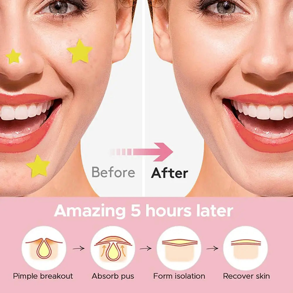 Acne Dot Patches Anti-allergy Sticker Star/Heart Shaped Acne Cover Patch Invisible Healing Acne Treatment Pimple Remover