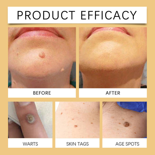 Herbal Mild Fade Skin Mole Skin Cleaning Care Cream