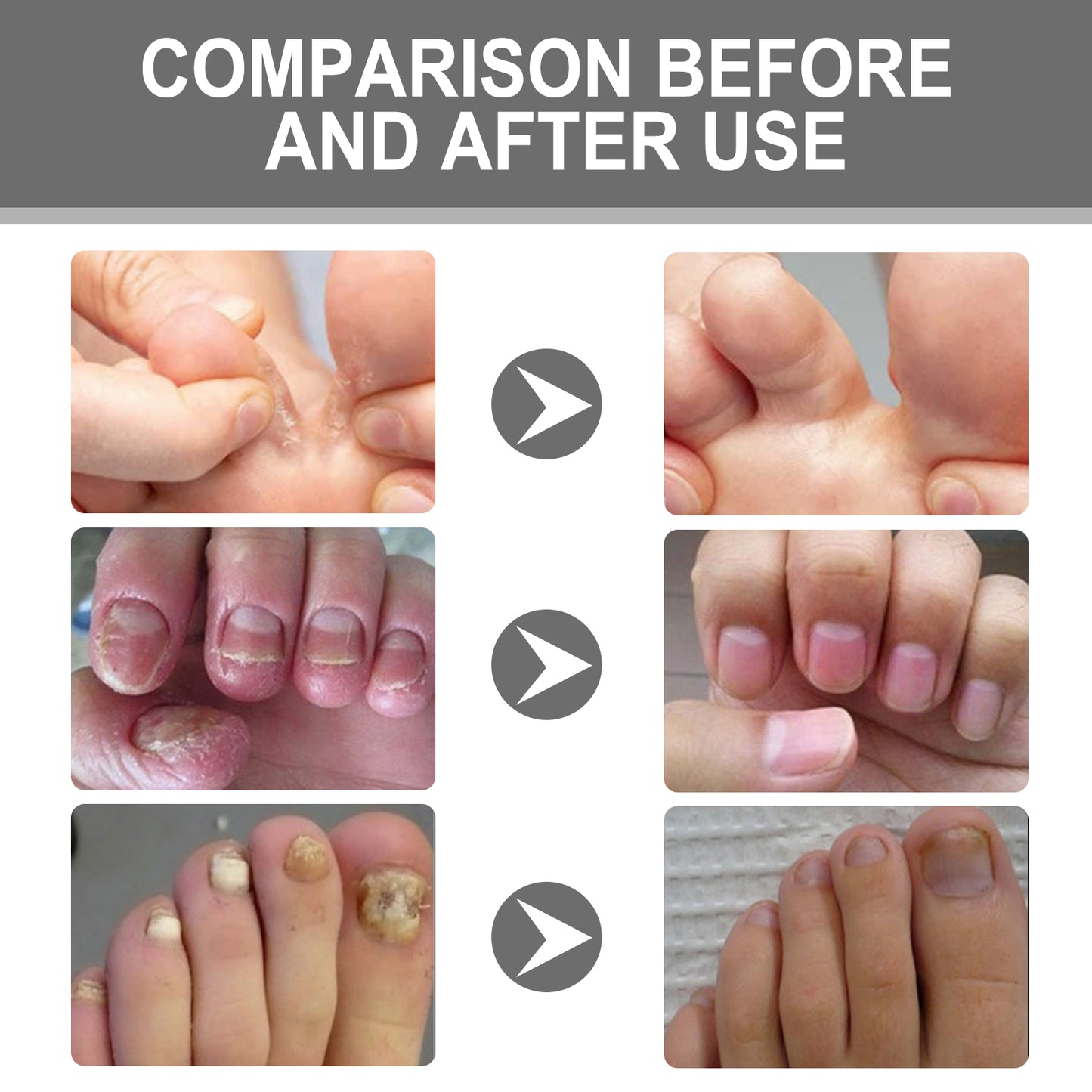 Nail Care Cream, Light Armor Repair Bad Ingrown Nail Nails Brothers Nail Thickening A Ditch Nursing