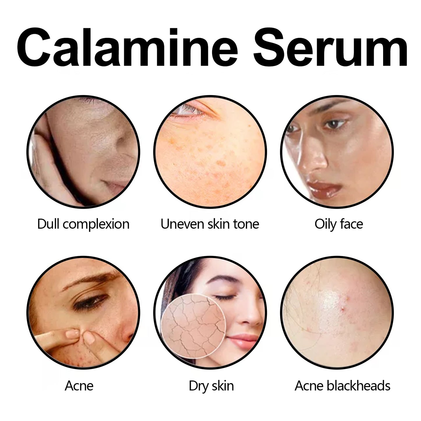 Calamine Serum, Improve Skin Dry Dull Acne Muscle Acne Hydrating Plump