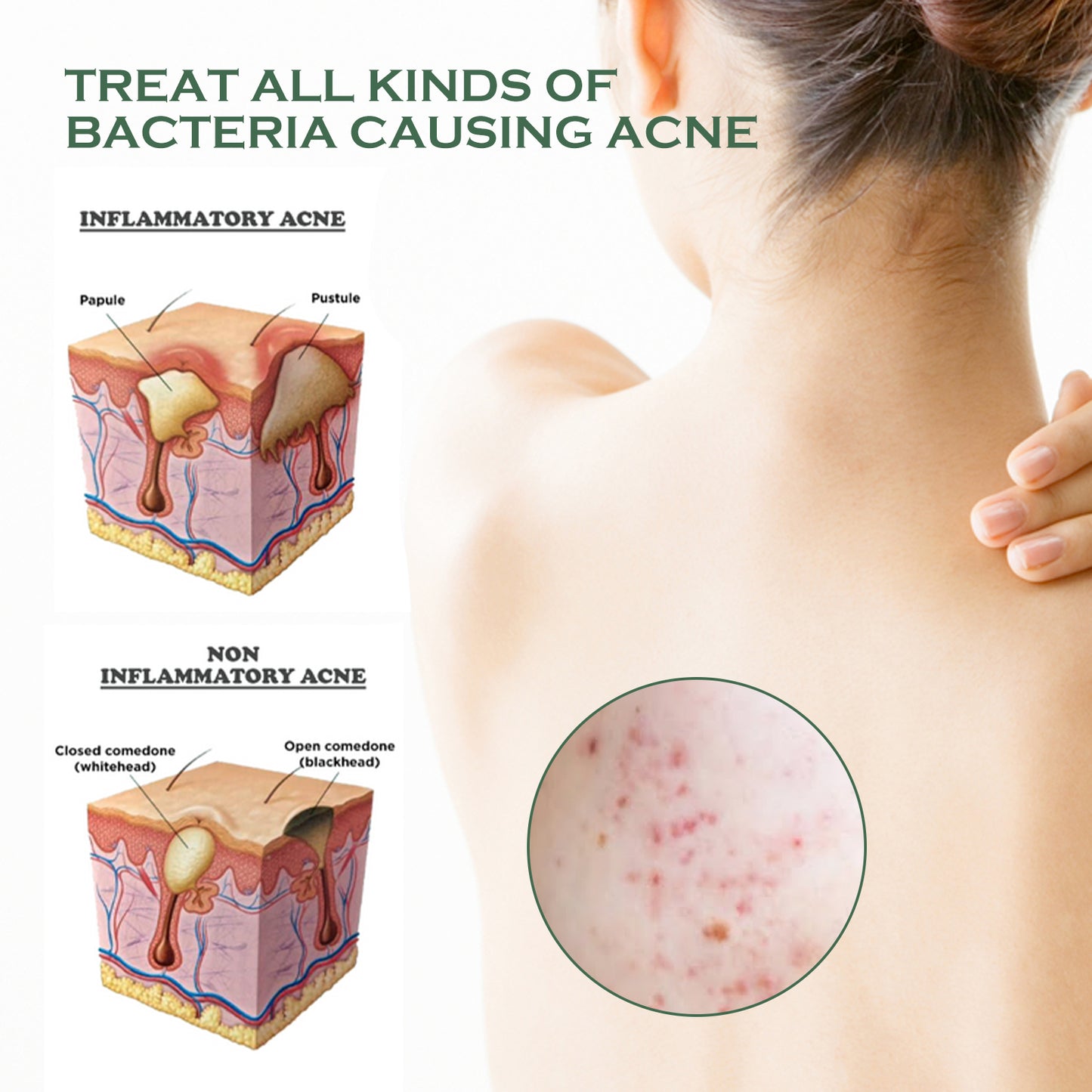 Body Acne Removal Cleanser Spray, Deep Clean Back Arm Fade Acne Beauty Moisturizing Spray