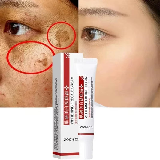 Whitening Freckle Cream Remove Dark Spots anti Freckle Face Creams Niacinamide Fade Pigmentation Melasma Brighten Skin Care 20G