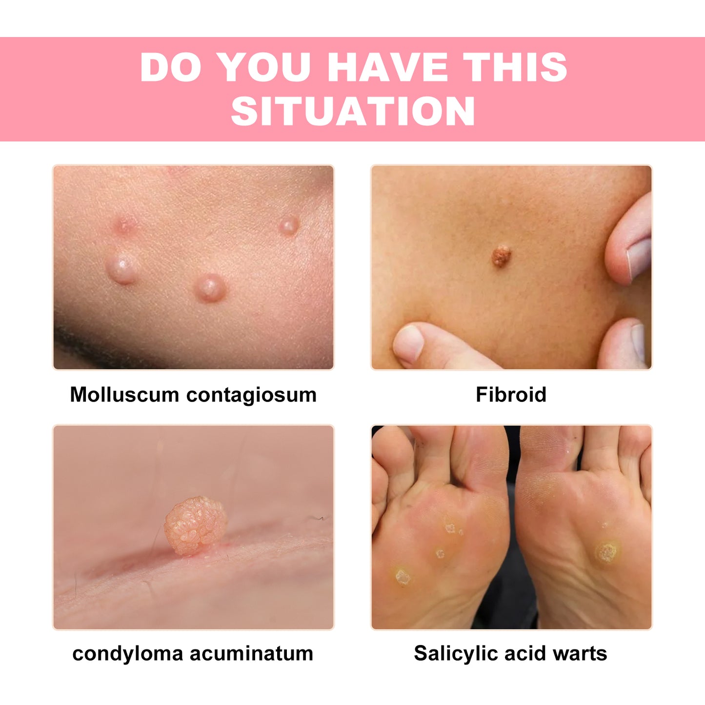 Skin Wart Lotion, Cleanses Skin And Removes Flat Eye Wart Lotion Especially Hand Cocoon
