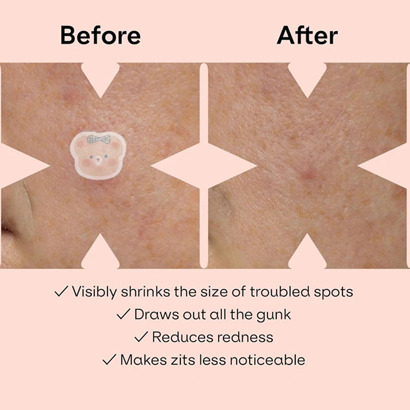 100PCS Cute Bear Pimple Patches | Colorful Hydrocolloid Acne Stickers with Strong Absorption