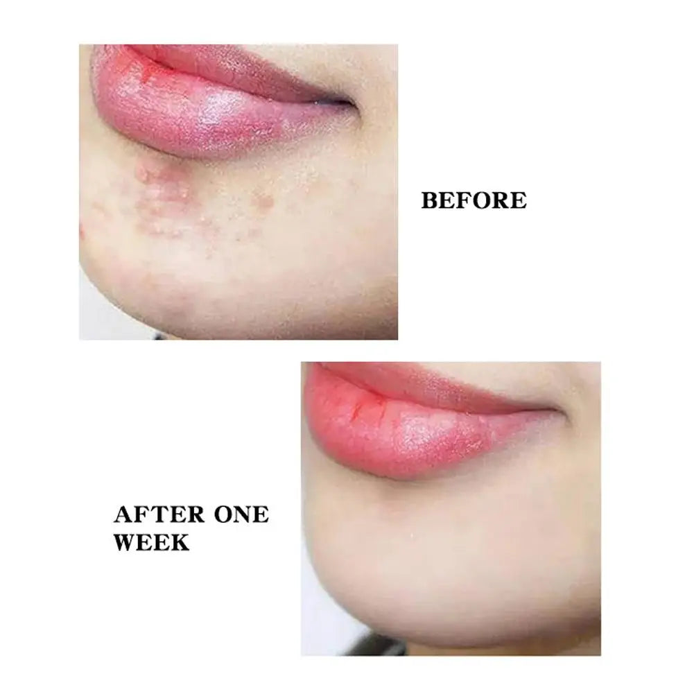 Acne Dot Patches Anti-allergy Sticker Star/Heart Shaped Acne Cover Patch Invisible Healing Acne Treatment Pimple Remover