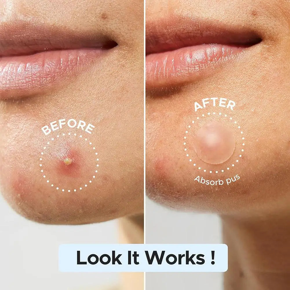 Acne Care Patch Anti-inflammatory Healing Absorbing Spot Sticker Covering Acne Skin Care Stickers Multiple Shapes Pimple Patch