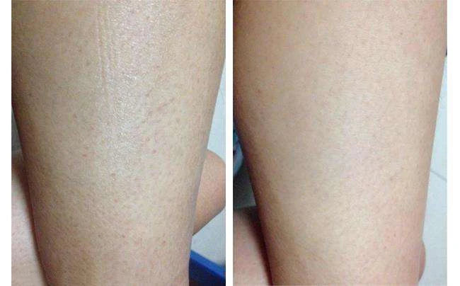300g/10.58 OZ Curing Keratosis Pilaris Chicken Skin Body Lotion Skin Repair Cream Skin Care Essence Moisturizing And Nourishing