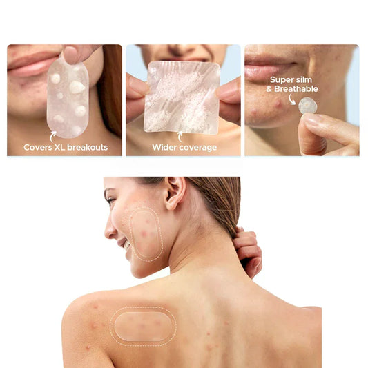Large Capacity Acne Patch Hydrocolloid Salicylic Transparent Acne Patch Invisible Acne Removal Skin Care Stickers Face Beauty