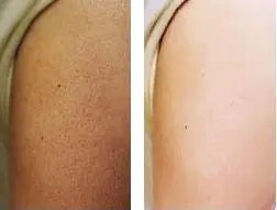 300g/10.58 OZ Curing Keratosis Pilaris Chicken Skin Body Lotion Skin Repair Cream Skin Care Essence Moisturizing And Nourishing