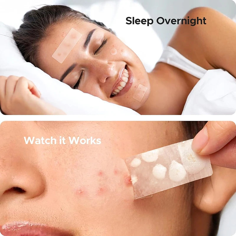 Large Capacity Acne Patch Hydrocolloid Salicylic Transparent Acne Patch Invisible Acne Removal Skin Care Stickers Face Beauty