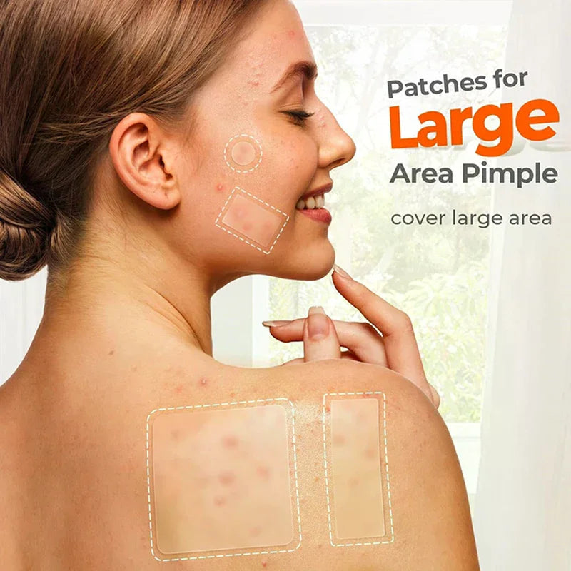 Large Capacity Acne Patch Hydrocolloid Salicylic Transparent Acne Patch Invisible Acne Removal Skin Care Stickers Face Beauty