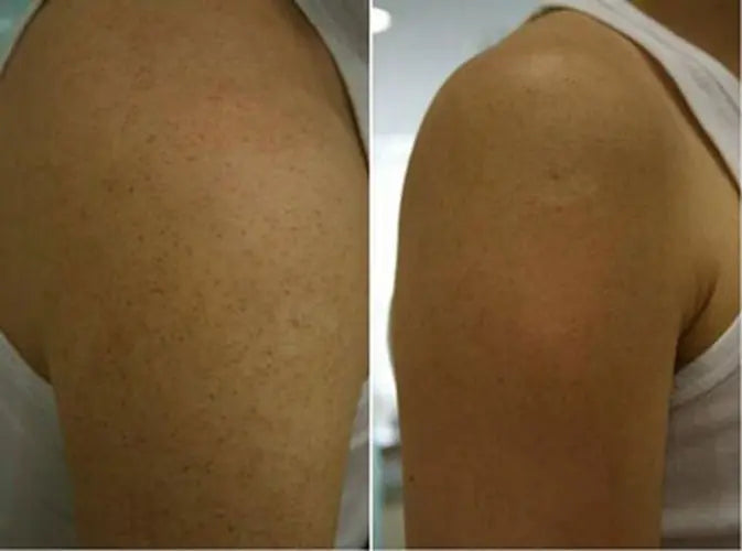 300g/10.58 OZ Curing Keratosis Pilaris Chicken Skin Body Lotion Skin Repair Cream Skin Care Essence Moisturizing And Nourishing