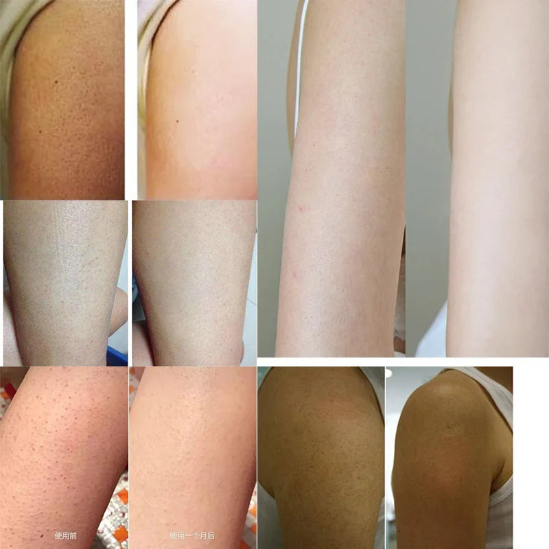 300g/10.58 OZ Curing Keratosis Pilaris Chicken Skin Body Lotion Skin Repair Cream Skin Care Essence Moisturizing And Nourishing